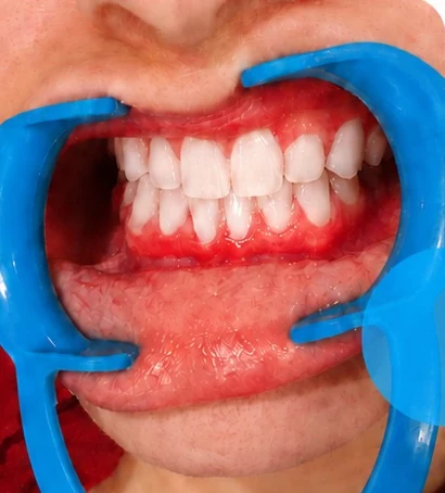 After professional whitening at Smile Savers