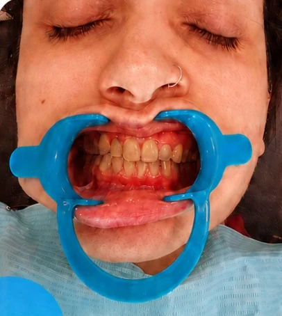 Before whitening: stained, yellowed teeth